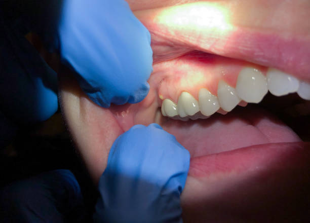 Best Emergency Gum Treatment in Laflin, PA